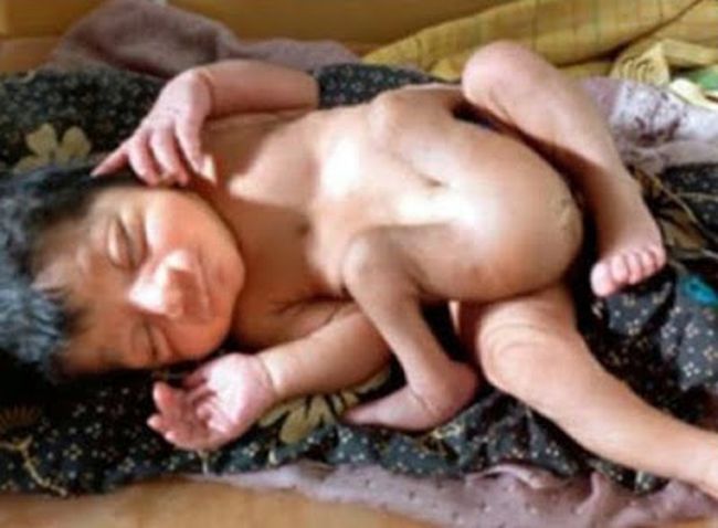 Baby Born With Four Legs And Two Pen!ses Described As Gift From God By Parents